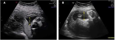 Alagille syndrome due to a de novo NOTCH2 mutation presenting as prenatal oligohydramnios and congenital bilateral renal hypodysplasia: A case report